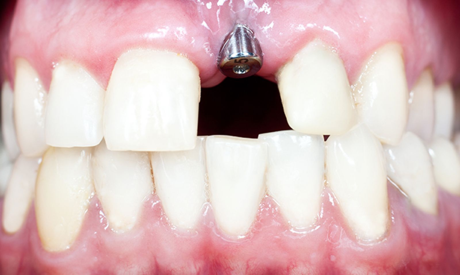 Dental implants: Dental bonding